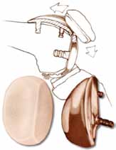 1974 Bechtol Patellofemoral Component