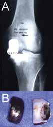 Fig. 2 Wrong component sizing or positioning may lead to edge loading (A) resulting in increased wear and implant failure (B).