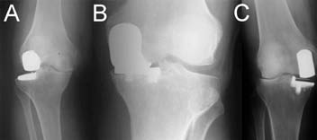 Fig. 3 Disease progression of the other compartment from overstuffi ng, over-correction or misbalance (A), early loosening (B) and wrong component positioning may lead UKA failure.