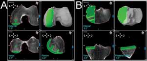 Fig. 4 Intraoperative screenshots of the robotic system showing the computer model of any anatomy based on preoperative CT-scans and allowing for precise positioning of the femoral (A) and tibial (B) components. 