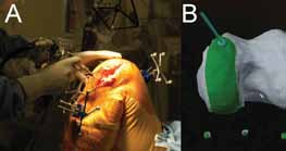 Fig. 5 Example of a system that uses a robotic arm with a high speed burr and gives the surgeon tactile feedback (A) when the planned resection depth is reached (B).74