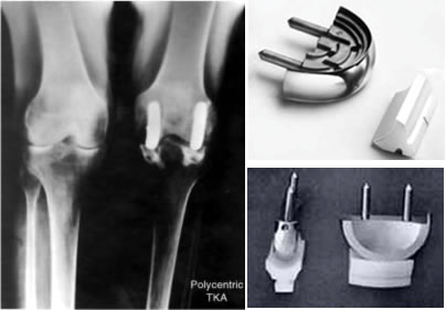 Polycentric Radiographic Post-op view and product