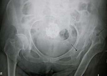 CDH of the left hip in an elderly person