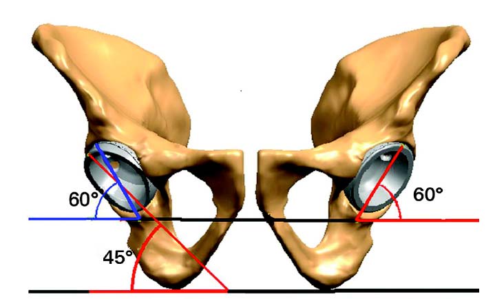 Left: diagram showing the 15° face-changing cup in the optimal position, with a cover angle with the liner of 60° (in blue), and a face-changing angle with the liner of 45° (in red). Right: diagram showing a ‘standard’ component incorrectly positioned at a high inclined angle of 60° to obtain full contact with host bone.