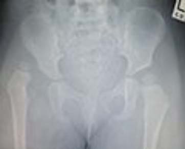 X-Ray Image Showing Hip Dysplasia in an Infant