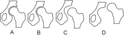 Types of misalignments of femoral head to the socket in hip dysplasia 9 A: Normal B: Dysplasia C: Subluxation D: Luxation