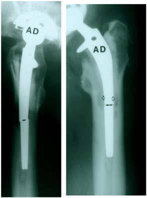 Fractured stem