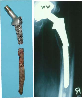Distal stem fixation can also result in a cantilever effect resulting in stem failure.