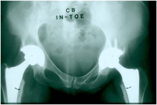 Proximal load transfer will reduce this cantilever effect.