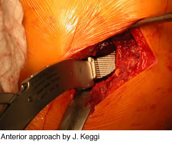 anterior-approach-img