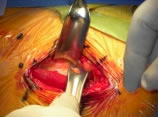 anterior-single-incision-img