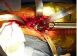 anterior-single-incision-img1