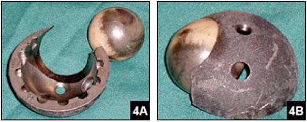 ceramic-head-metal-shell-failure-img