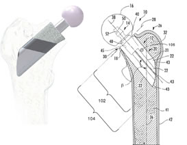 Neck Sparing Total Hip Implant Methods
