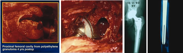 polyethylene-induced-osteolysis-img