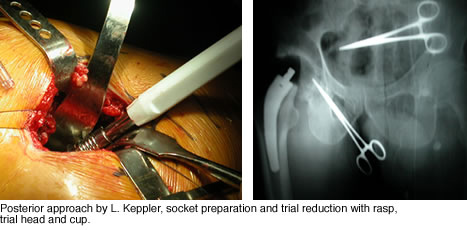 posterior-approach-img