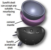 Low Stress Multiple Fixation Acetabular Component