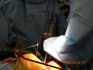 surgical-technique-perls-img8