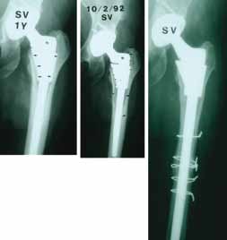 Porous sleeve failed to in-grow