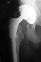 S-Rom grooved style stem progressive osteolysis