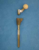 S-Rom grooved style stem progressive osteolysis